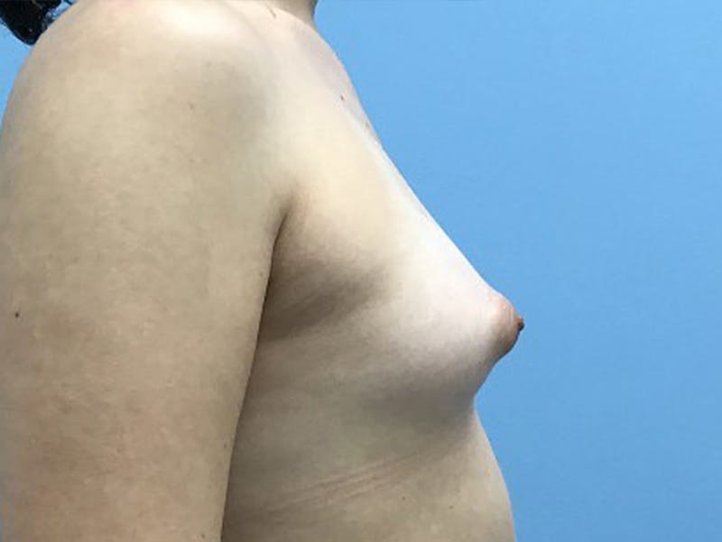 Breast Augmentation Before & After Gallery - Patient 120905652 - Image 3