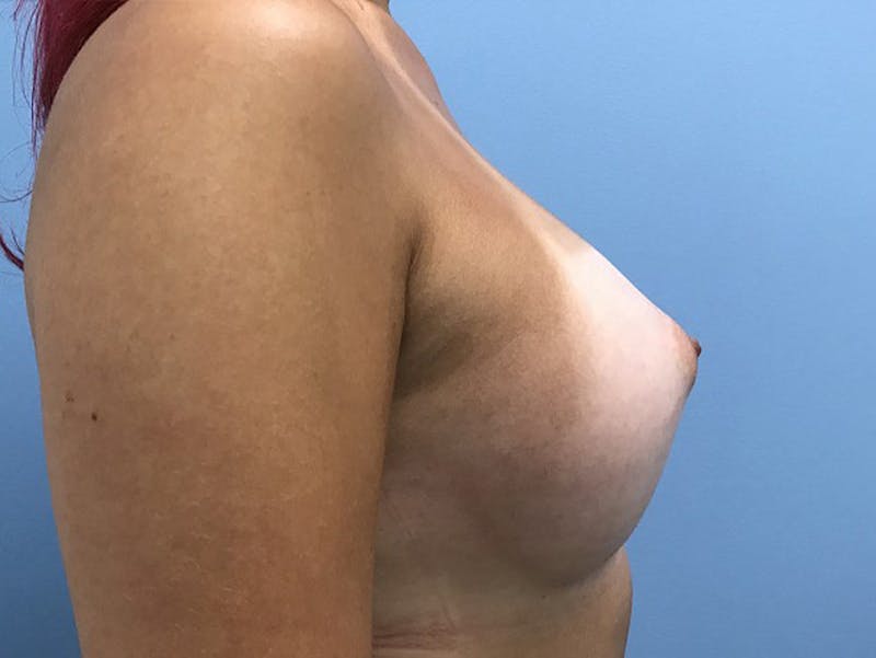 Breast Augmentation Before & After Gallery - Patient 120905652 - Image 4