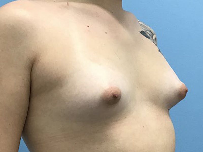 Breast Augmentation Gallery - Patient 120905652 - Image 5