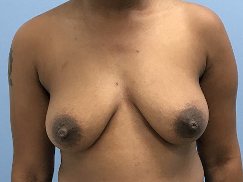 Top Surgery Before & After Gallery - Patient 120905659 - Image 1
