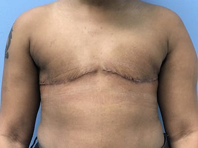 Top Surgery Before & After Gallery - Patient 120905659 - Image 2