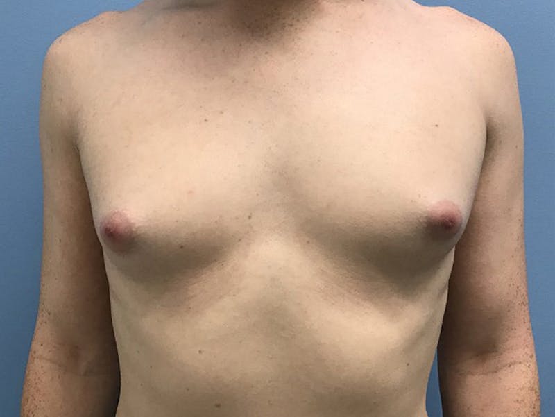Breast Augmentation Before & After Gallery - Patient 120905662 - Image 1