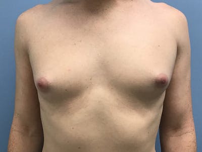 隆胸前后图库-患者120905662 -图1