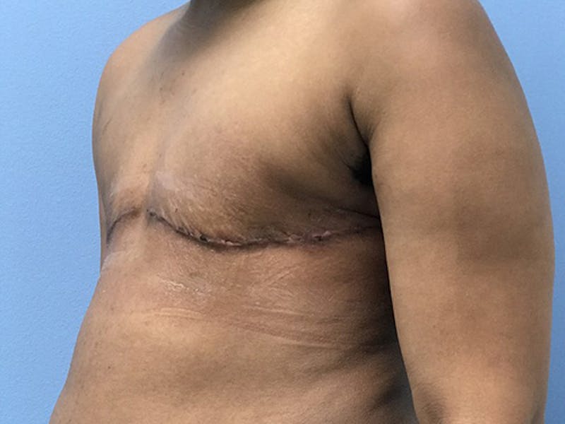Top Surgery Before & After Gallery - Patient 120905659 - Image 4