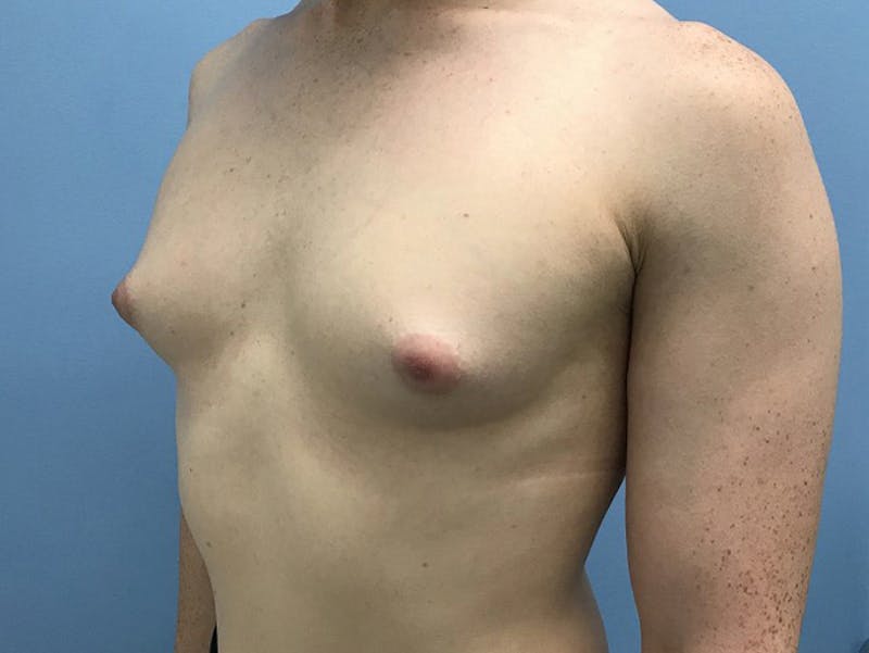 Breast Augmentation Before & After Gallery - Patient 120905662 - Image 3