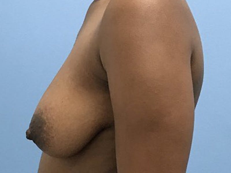 Top Surgery Before & After Gallery - Patient 120905659 - Image 5