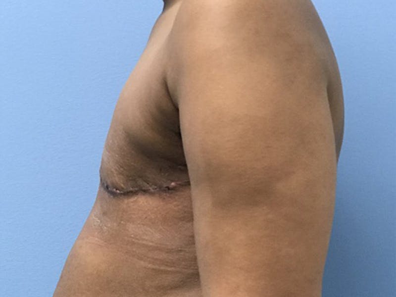 Top Surgery Before & After Gallery - Patient 120905659 - Image 6