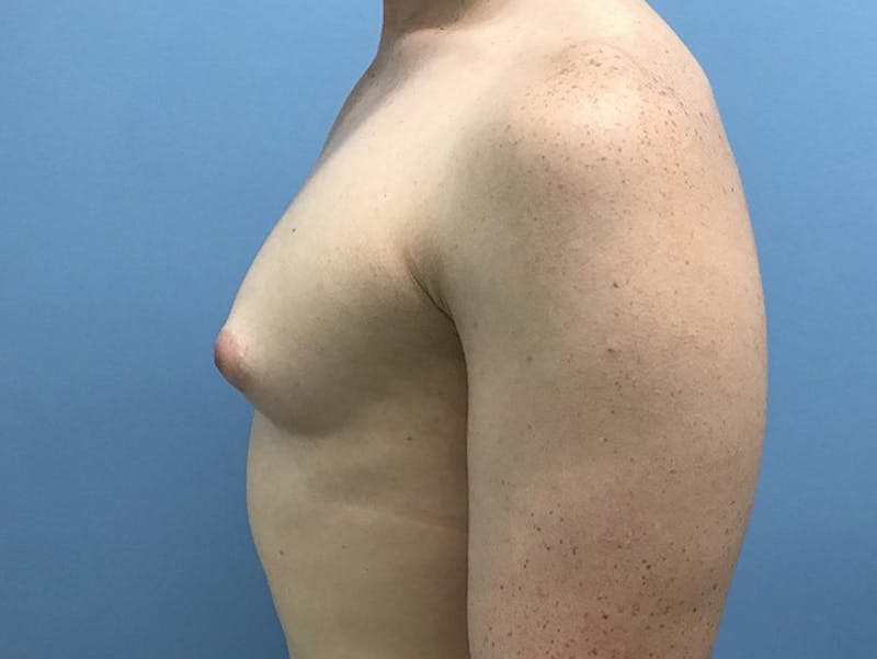 Breast Augmentation Before & After Gallery - Patient 120905662 - Image 5
