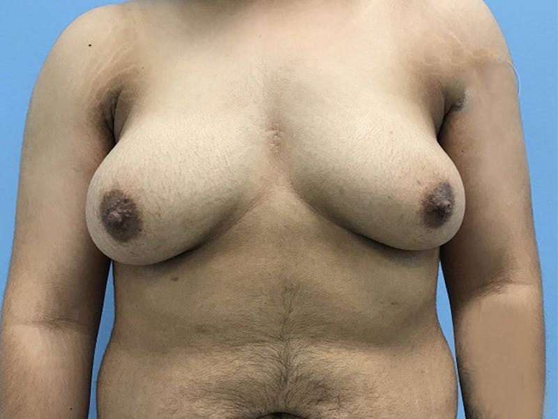 Top Surgery Gallery - Patient 120905665 - Image 1