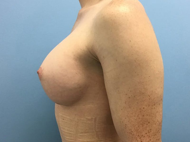Breast Augmentation Gallery - Patient 120905662 - Image 6