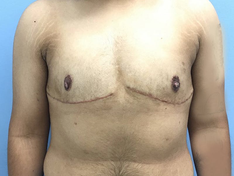 Top Surgery Before & After Gallery - Patient 120905665 - Image 2