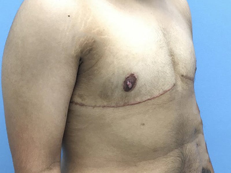 Top Surgery Before & After Gallery - Patient 120905665 - Image 4