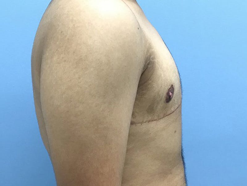 Top Surgery Before & After Gallery - Patient 120905665 - Image 6