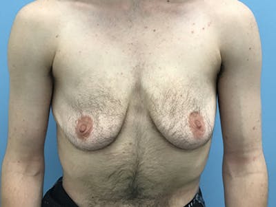 Top Surgery Before & After Gallery - Patient 120905669 - Image 1
