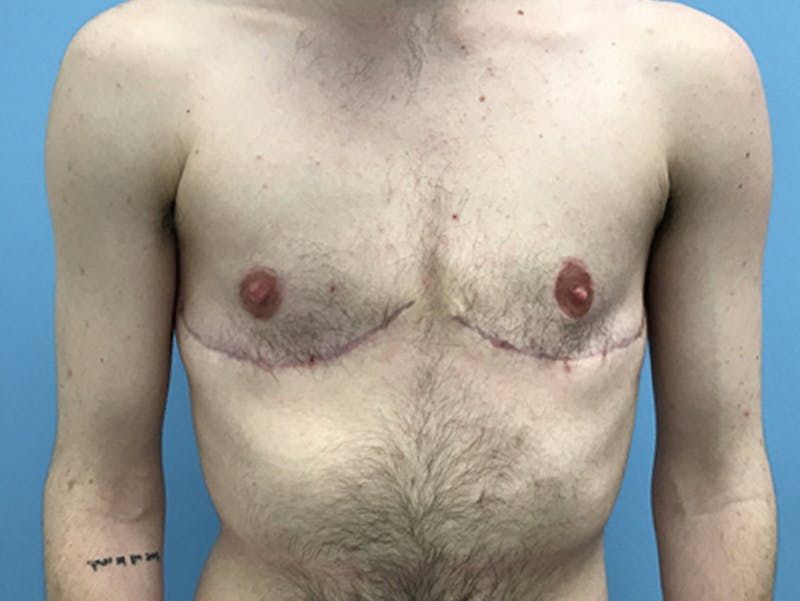 Top Surgery Before & After Gallery - Patient 120905669 - Image 2