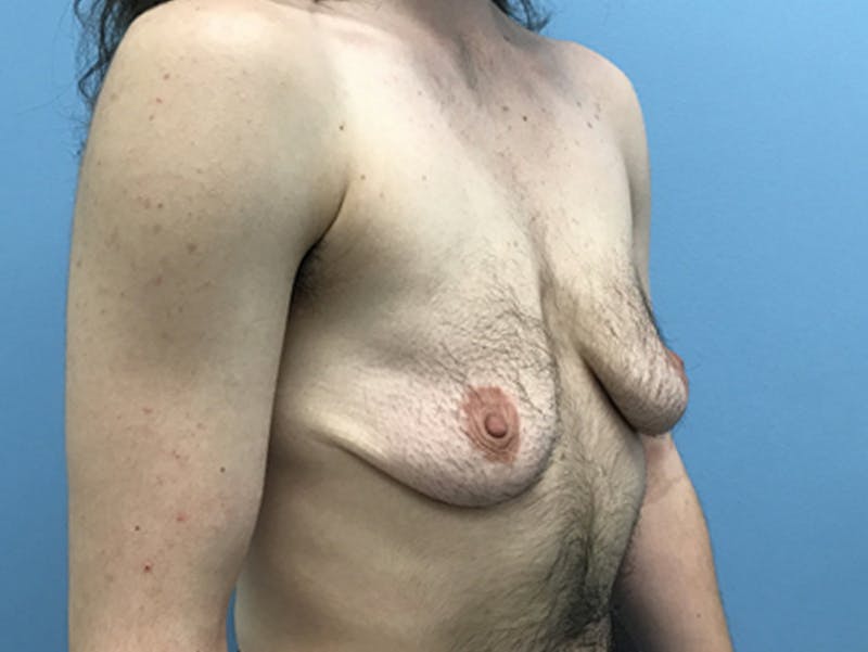 Top Surgery Before & After Gallery - Patient 120905669 - Image 3