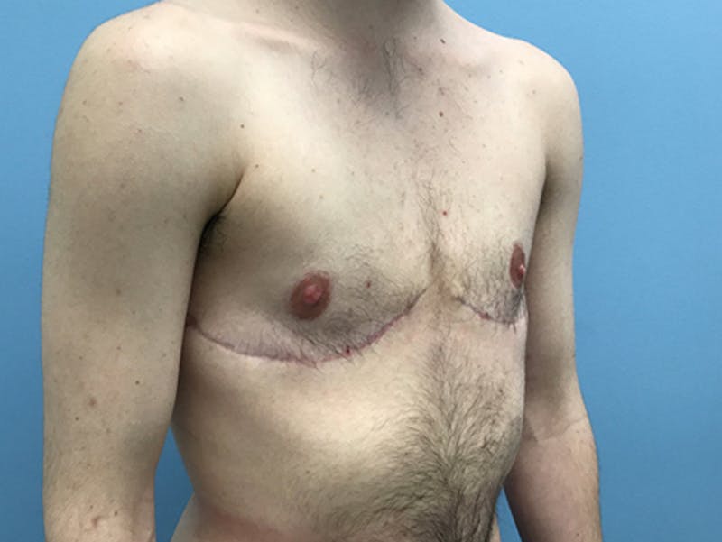 Top Surgery Before & After Gallery - Patient 120905669 - Image 4