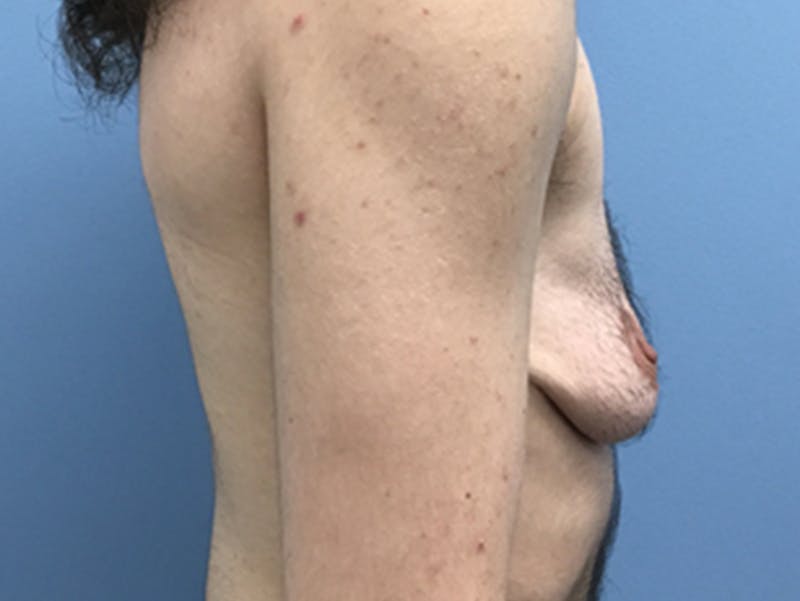 Top Surgery Before & After Gallery - Patient 120905669 - Image 5