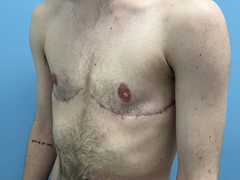 Top Surgery Before & After Gallery - Patient 120905669 - Image 8