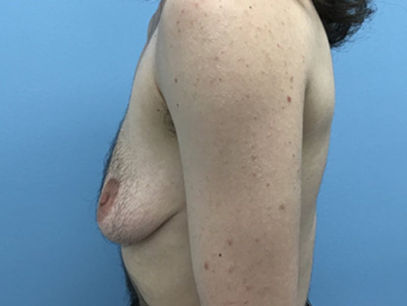 Top Surgery Before & After Gallery - Patient 120905669 - Image 9