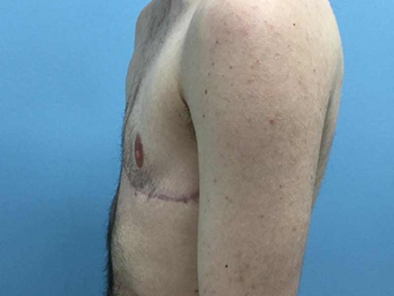 Top Surgery Before & After Gallery - Patient 120905669 - Image 10