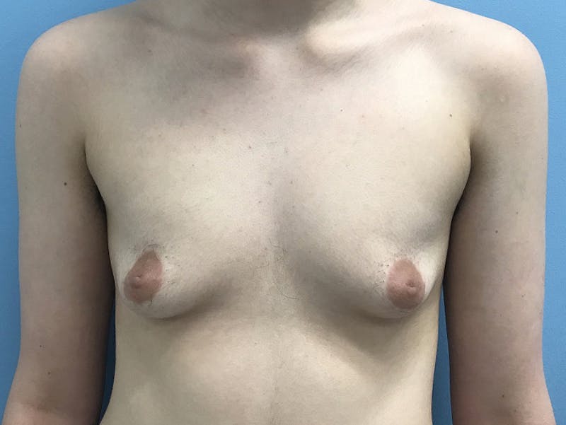 Top Surgery Before & After Gallery - Patient 120905673 - Image 1