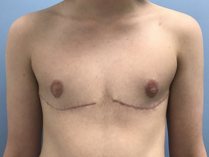 Top Surgery Before & After Gallery - Patient 120905673 - Image 2