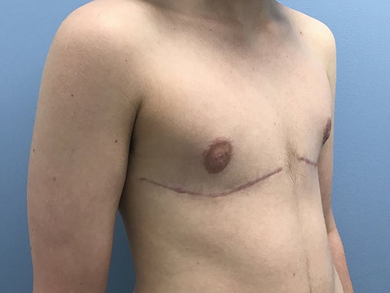 Top Surgery Before & After Gallery - Patient 120905673 - Image 4