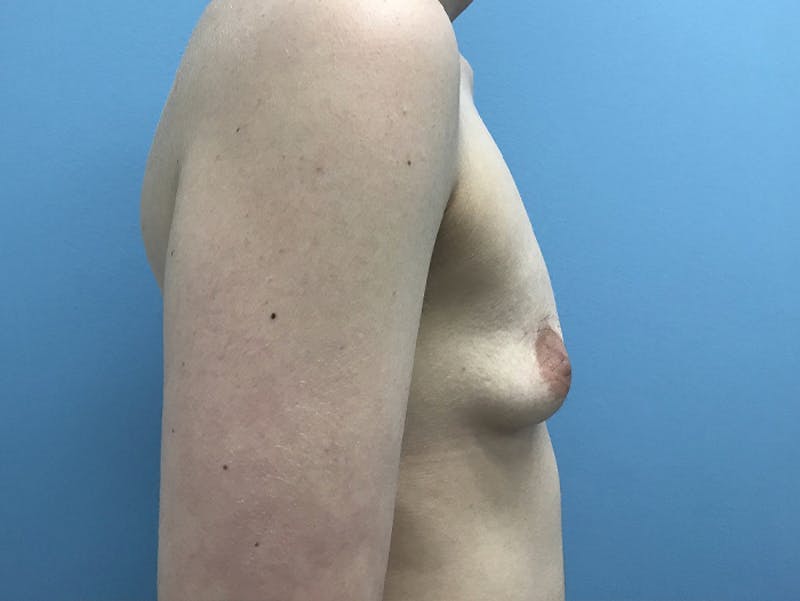 Top Surgery Before & After Gallery - Patient 120905673 - Image 5