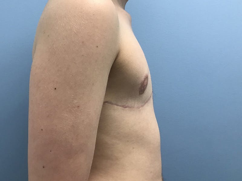 Top Surgery Before & After Gallery - Patient 120905673 - Image 6