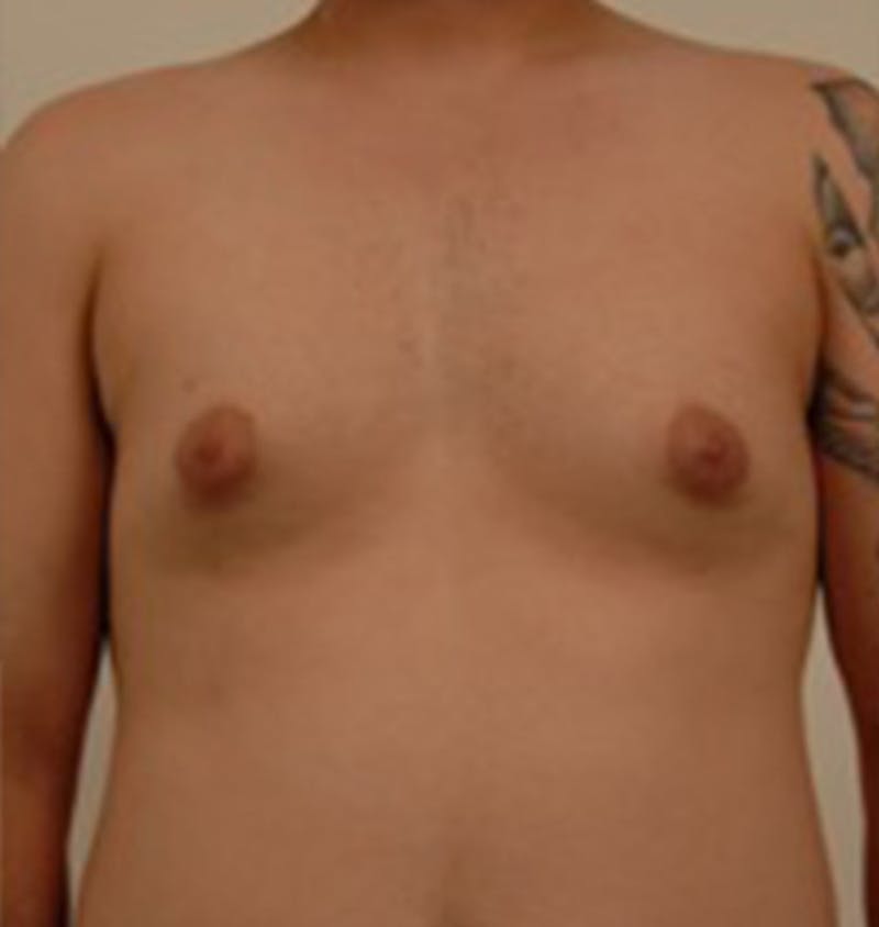 Gynecomastia Before & After Gallery - Patient 120905674 - Image 1