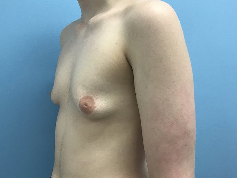 Top Surgery Before & After Gallery - Patient 120905673 - Image 7