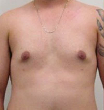 男性乳房发育前后图库-患者120905674 -图2