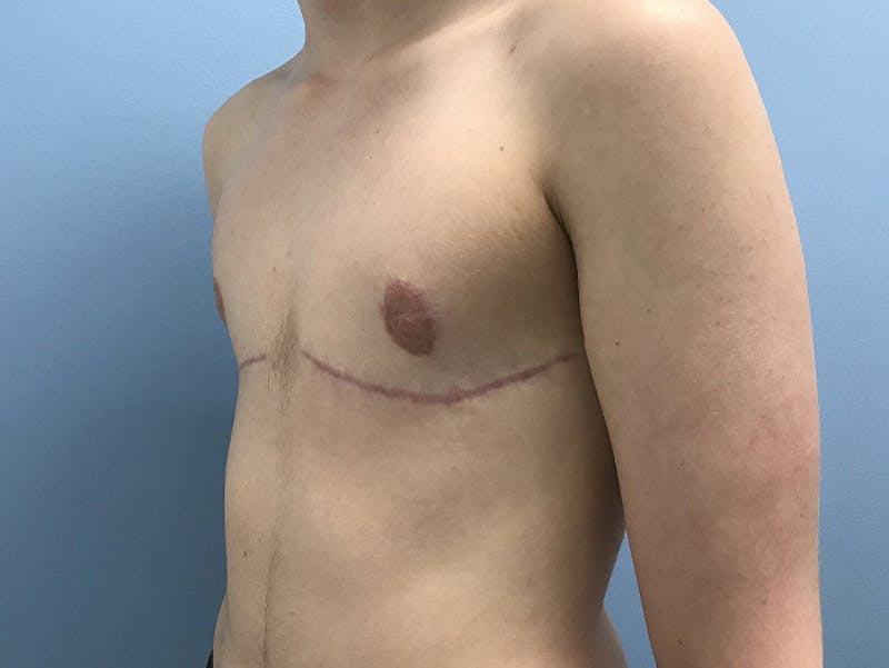 Top Surgery Before & After Gallery - Patient 120905673 - Image 8