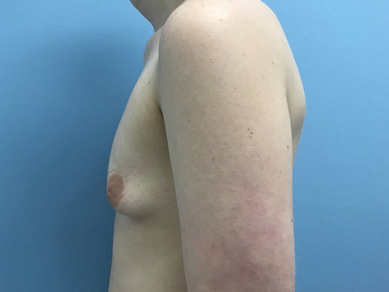 Top Surgery Before & After Gallery - Patient 120905673 - Image 9