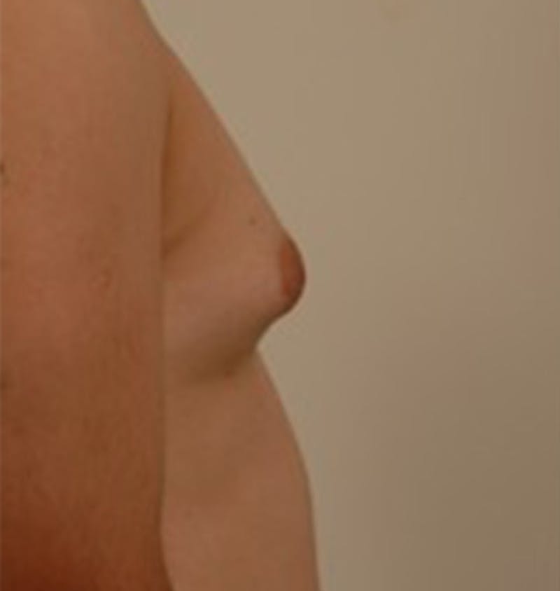 Gynecomastia Gallery - Patient 120905674 - Image 5