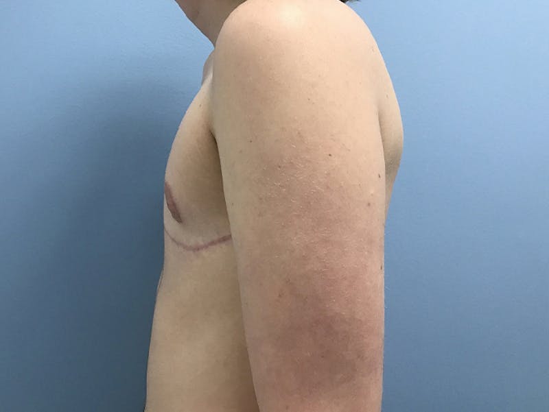 Top Surgery Before & After Gallery - Patient 120905673 - Image 10