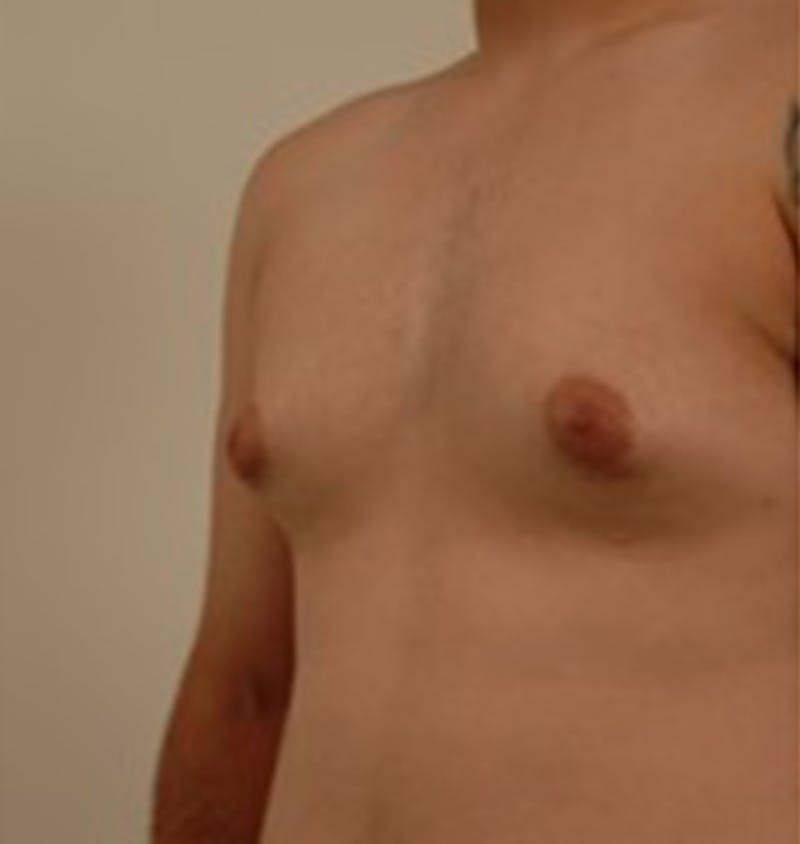 Gynecomastia Before & After Gallery - Patient 120905674 - Image 7