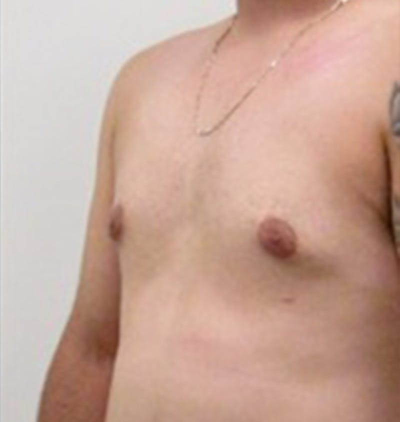 Gynecomastia Before & After Gallery - Patient 120905674 - Image 8