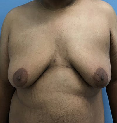 男性乳房发育前后图库-患者120905676 -图片1