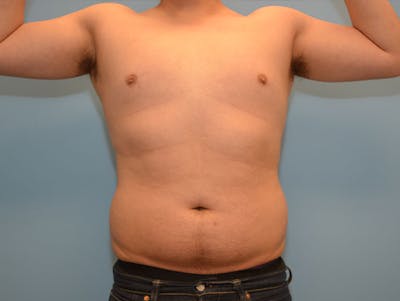 Liposuction Before & After Gallery - Patient 120905675 - Image 1