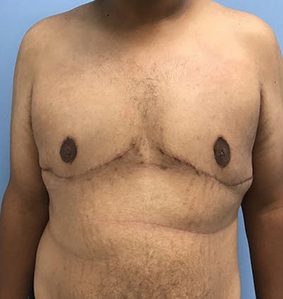 男性乳房发育前后图库-患者120905676 -图2