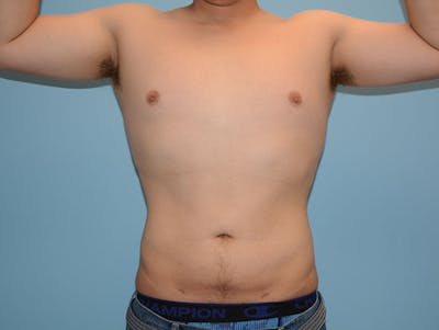 Liposuction Before & After Gallery - Patient 120905675 - Image 2