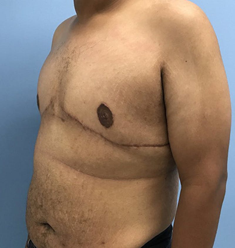 Gynecomastia Before & After Gallery - Patient 120905676 - Image 4