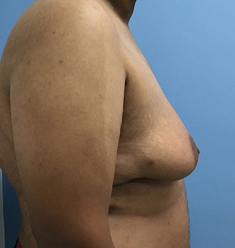 Gynecomastia Before & After Gallery - Patient 120905676 - Image 5