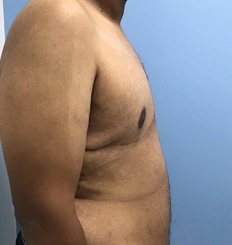 Gynecomastia Before & After Gallery - Patient 120905676 - Image 6