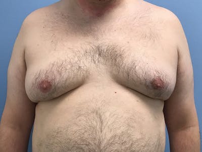 男性乳房发育前后图库-患者120905678 -图1