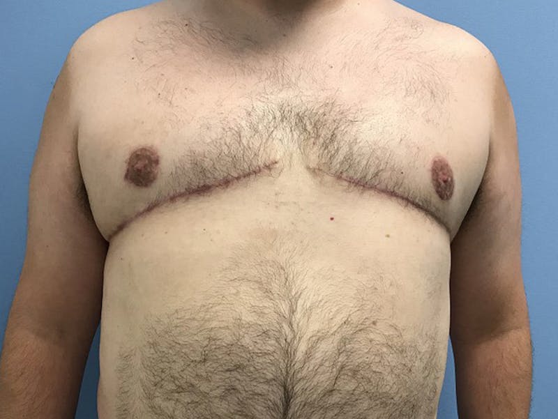 Gynecomastia Before & After Gallery - Patient 120905678 - Image 2