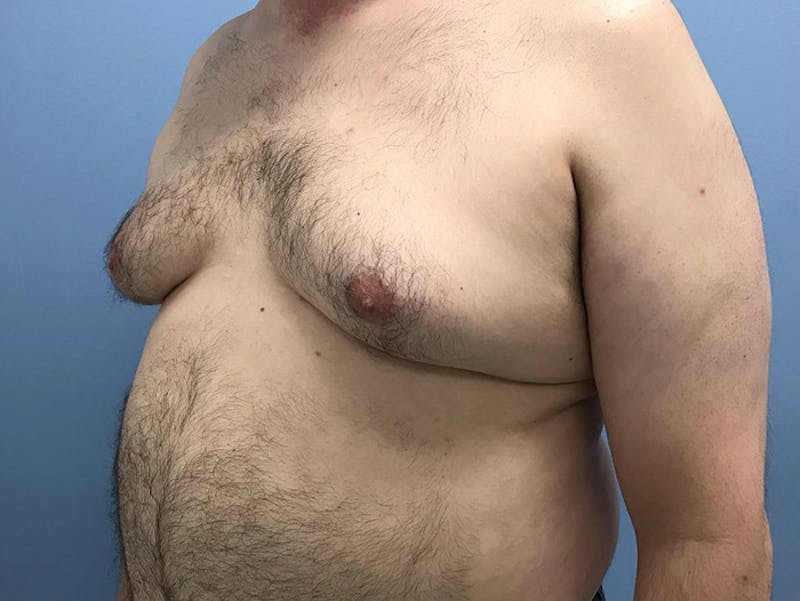 Gynecomastia Before & After Gallery - Patient 120905678 - Image 3