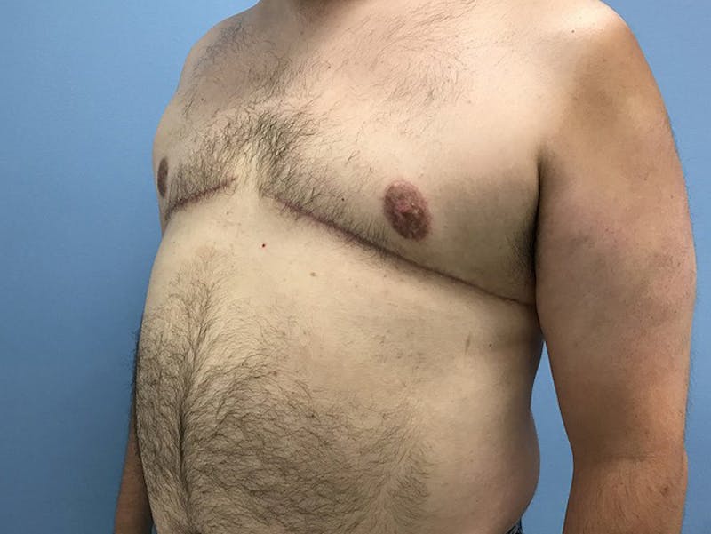 Gynecomastia Before & After Gallery - Patient 120905678 - Image 4